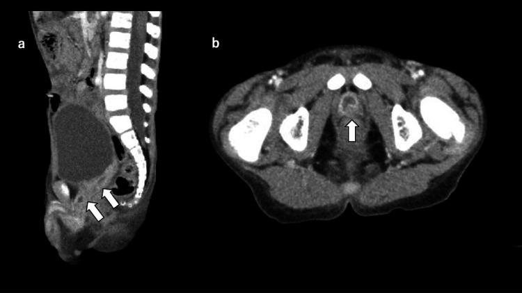 https://cdn.ncbi.nlm.nih.gov/pmc/blobs/aee3/9378941/88db01d91106/cureus-0014-00000026941-i01.jpg