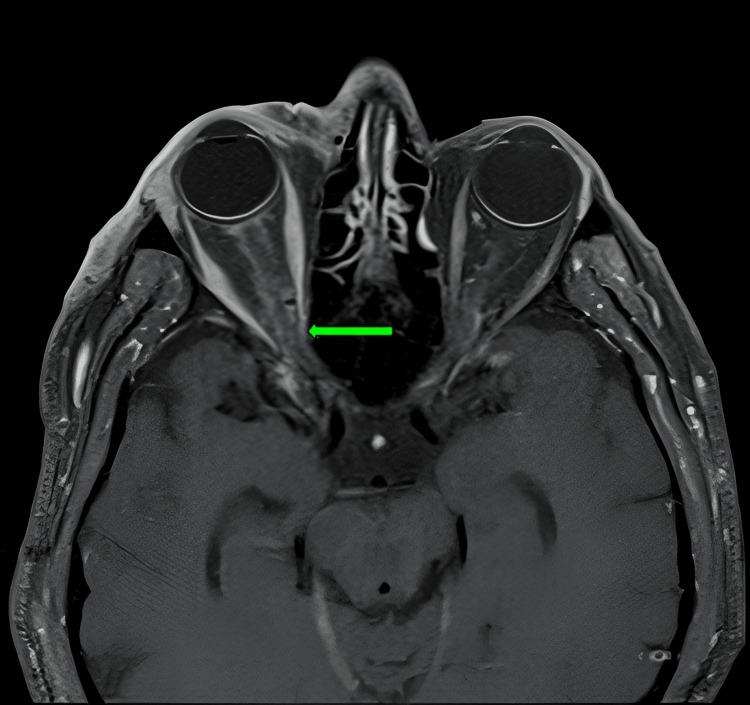 https://cdn.ncbi.nlm.nih.gov/pmc/blobs/af36/12076090/4dee68123e0d/cureus-0017-00000082219-i01.jpg