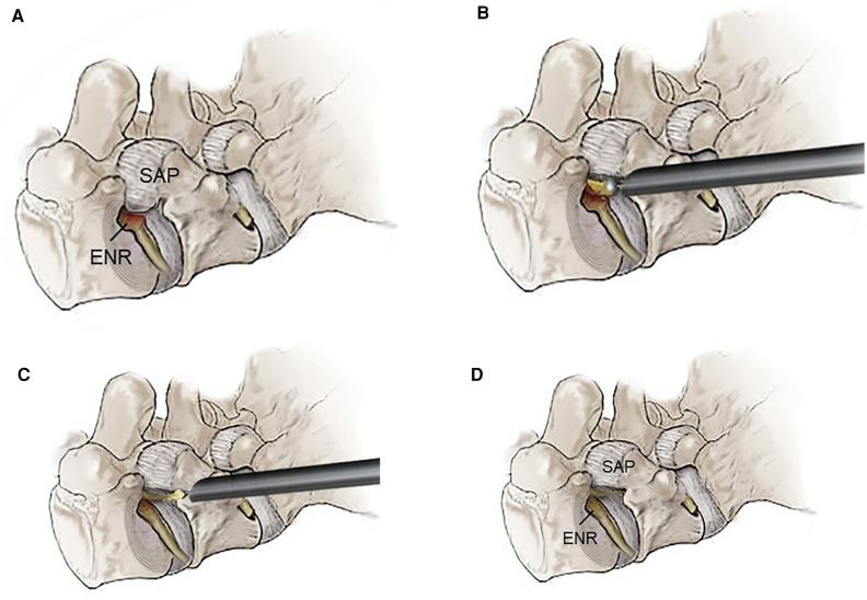 https://cdn.ncbi.nlm.nih.gov/pmc/blobs/af56/10867165/23c1f7f51574/fsurg-11-1324843-g001.jpg