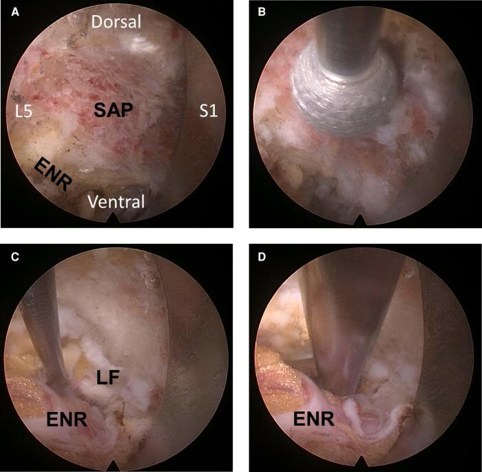 https://cdn.ncbi.nlm.nih.gov/pmc/blobs/af56/10867165/406cb8e95910/fsurg-11-1324843-g002.jpg