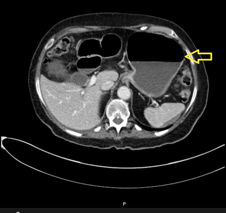 https://cdn.ncbi.nlm.nih.gov/pmc/blobs/b03e/10914080/0c21d3b2c086/cureus-0016-00000053564-i02.jpg