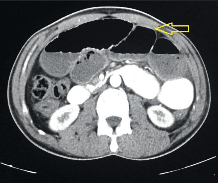 https://cdn.ncbi.nlm.nih.gov/pmc/blobs/b03e/10914080/1aedbf530ac0/cureus-0016-00000053564-i05.jpg