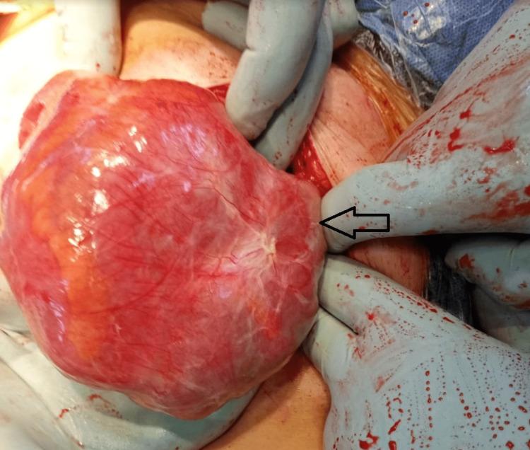 https://cdn.ncbi.nlm.nih.gov/pmc/blobs/b03e/10914080/6963071c90f2/cureus-0016-00000053564-i07.jpg
