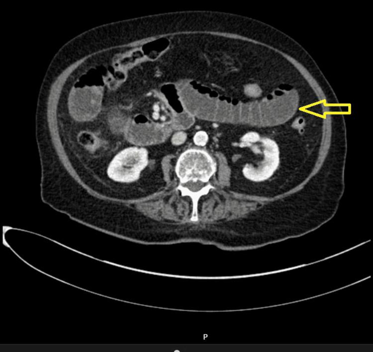https://cdn.ncbi.nlm.nih.gov/pmc/blobs/b03e/10914080/6d71a8197d9b/cureus-0016-00000053564-i03.jpg
