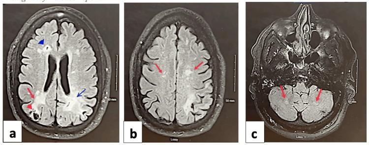 https://cdn.ncbi.nlm.nih.gov/pmc/blobs/b071/10568952/130ca54c3300/cureus-0015-00000045091-i01.jpg