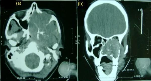 https://cdn.ncbi.nlm.nih.gov/pmc/blobs/b077/3195723/013ce0e218a7/1477-7819-9-118-1.jpg