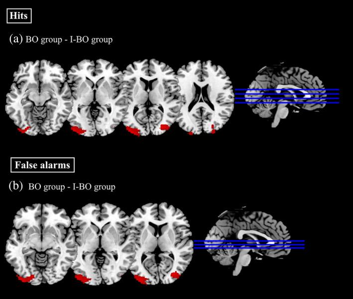 https://cdn.ncbi.nlm.nih.gov/pmc/blobs/b07a/7268037/0ca5f1ea298c/HBM-41-1904-g004.jpg