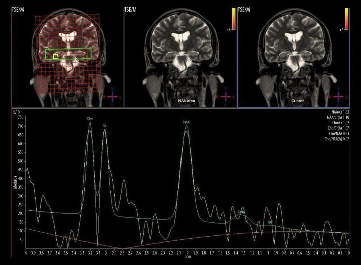 https://cdn.ncbi.nlm.nih.gov/pmc/blobs/b0d3/3908511/cfde2280597d/poljradiol-78-4-7-g004.jpg