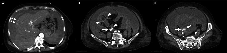 https://cdn.ncbi.nlm.nih.gov/pmc/blobs/b0e4/12322941/dc1350308b79/cureus-0017-00000087367-i01.jpg