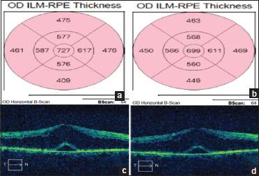 https://cdn.ncbi.nlm.nih.gov/pmc/blobs/b0e8/10697263/c541608061aa/OJO-16-509-g006.jpg