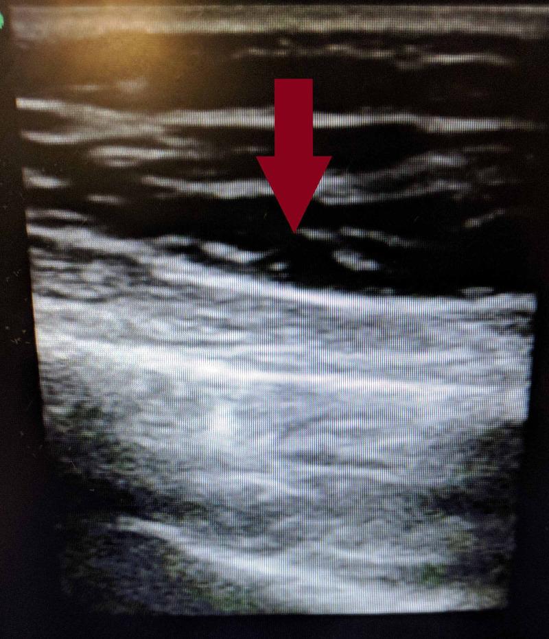 https://cdn.ncbi.nlm.nih.gov/pmc/blobs/b0ef/7781785/d9687944d851/cureus-0012-00000011880-i03.jpg