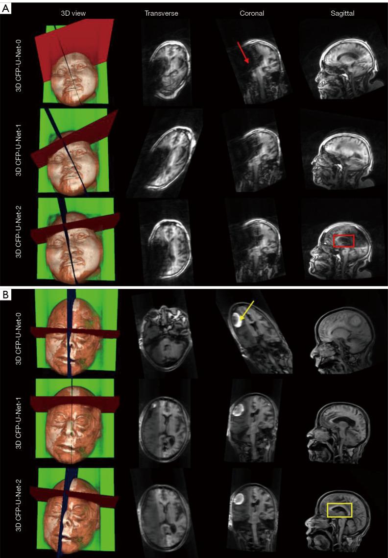 https://cdn.ncbi.nlm.nih.gov/pmc/blobs/b133/11151238/8e5af3b562ff/qims-14-06-4015-f8.jpg