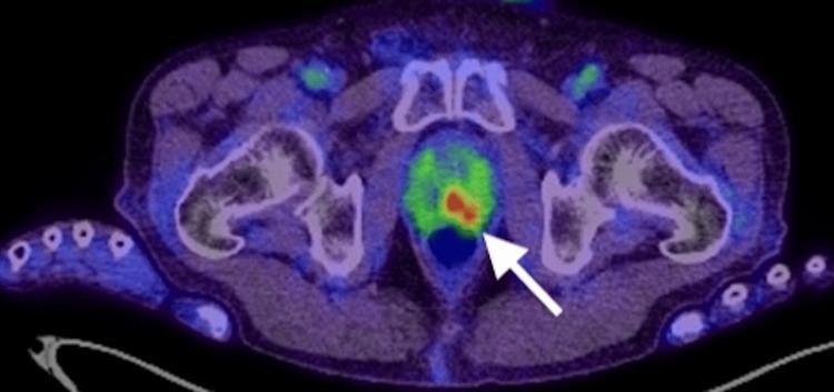 https://cdn.ncbi.nlm.nih.gov/pmc/blobs/b17a/12357750/756f6f208ef1/cureus-0017-00000088048-i01.jpg