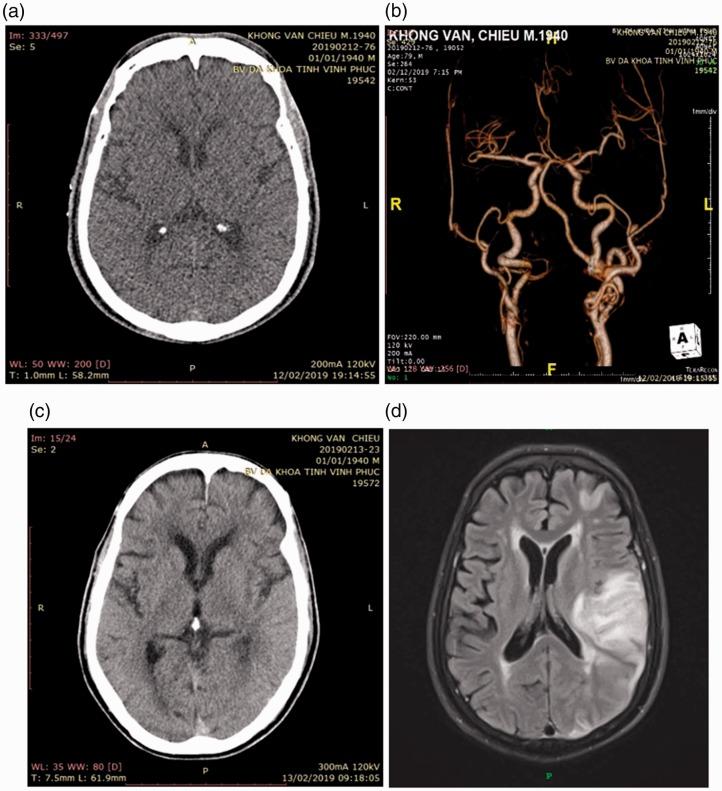 https://cdn.ncbi.nlm.nih.gov/pmc/blobs/b1db/6753530/b86ee86f37f4/10.1177_0300060519865626-fig2.jpg