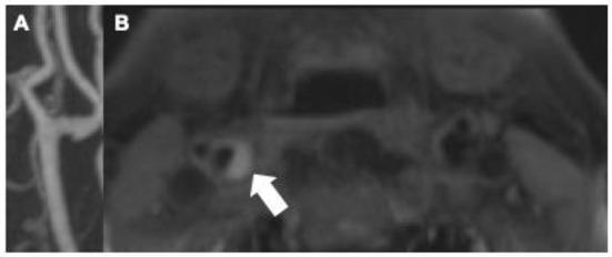 https://cdn.ncbi.nlm.nih.gov/pmc/blobs/b209/9459011/1f189152b698/fneur-13-982896-g0001.jpg