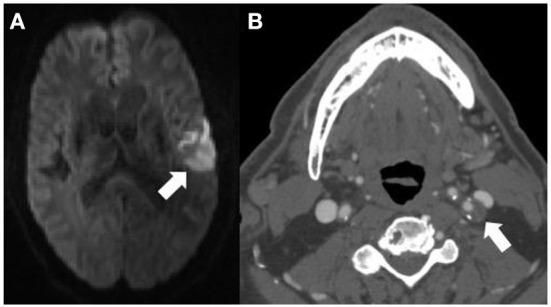 https://cdn.ncbi.nlm.nih.gov/pmc/blobs/b209/9459011/fa01ad087419/fneur-13-982896-g0002.jpg