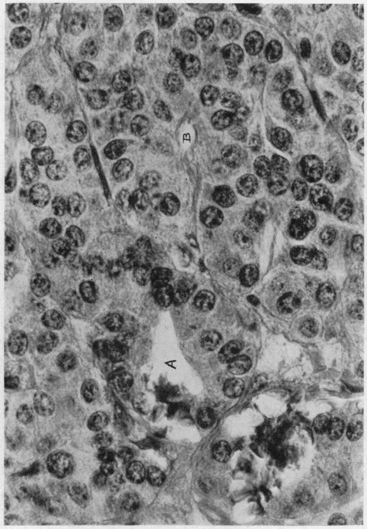 https://cdn.ncbi.nlm.nih.gov/pmc/blobs/b216/1390871/cd2140e848b8/annsurg00555-0022-d.jpg