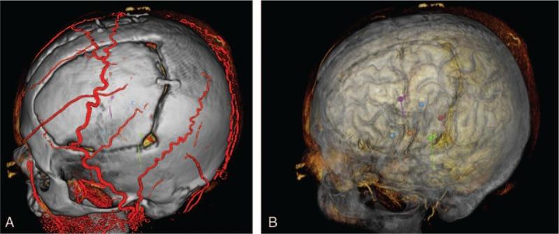 https://cdn.ncbi.nlm.nih.gov/pmc/blobs/b22b/5466233/92ff628b6bfd/medi-96-e7106-g004.jpg