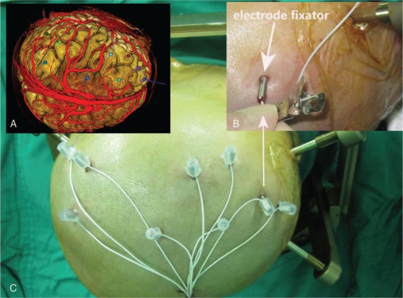 https://cdn.ncbi.nlm.nih.gov/pmc/blobs/b22b/5466233/c128ad997c07/medi-96-e7106-g003.jpg