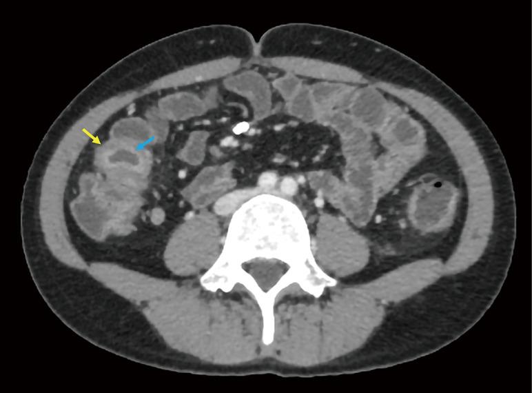 https://cdn.ncbi.nlm.nih.gov/pmc/blobs/b267/12332658/b0551266d51a/qims-15-08-6910-f4.jpg