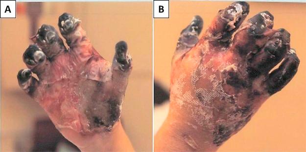 https://cdn.ncbi.nlm.nih.gov/pmc/blobs/b26f/5826729/d7ddad643bd9/radcr389-fig-0002.jpg