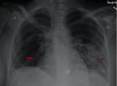 https://cdn.ncbi.nlm.nih.gov/pmc/blobs/b26f/7666633/6cb98a5f2c01/CRIID2020-8850340.001.jpg