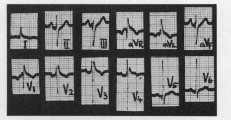 https://cdn.ncbi.nlm.nih.gov/pmc/blobs/b2db/1017662/e01873d43c72/brheartj00368-0014-b.jpg