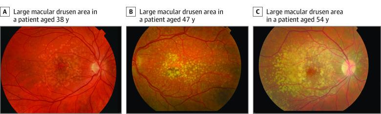 https://cdn.ncbi.nlm.nih.gov/pmc/blobs/b2df/8517879/b44f91c1d272/jamaophthalmol-e214102-g003.jpg