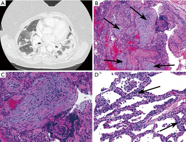 https://cdn.ncbi.nlm.nih.gov/pmc/blobs/b2ec/8482343/d54fc4345c50/jtd-13-09-5556-f3.jpg