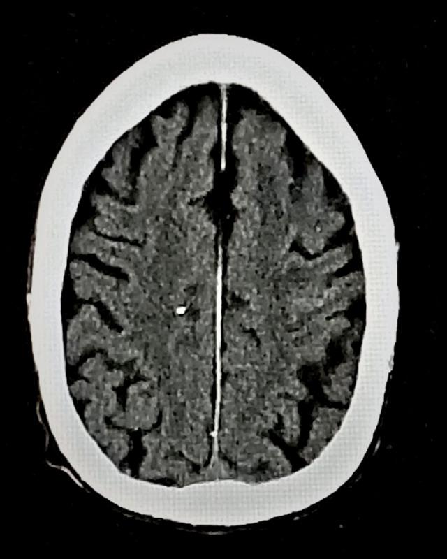https://cdn.ncbi.nlm.nih.gov/pmc/blobs/b31f/8130978/315d7ad595f6/amjcaserep-22-e931376-g008.jpg