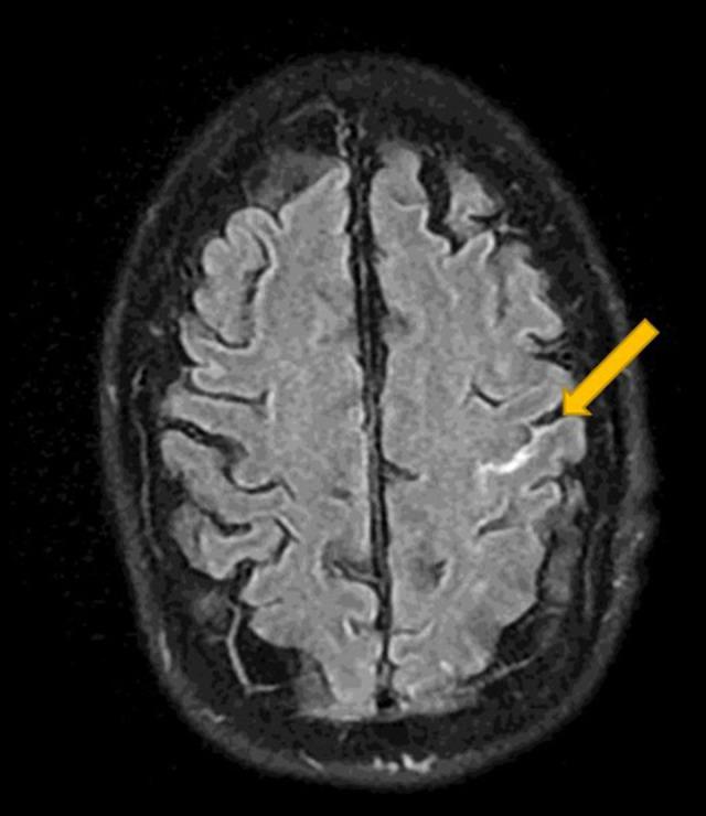 https://cdn.ncbi.nlm.nih.gov/pmc/blobs/b31f/8130978/d5dda21b9b42/amjcaserep-22-e931376-g002.jpg