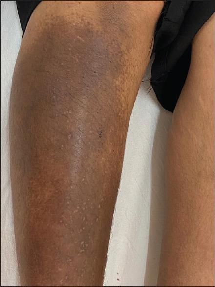 https://cdn.ncbi.nlm.nih.gov/pmc/blobs/b361/10238991/7cee6b9589de/IJD-68-205-g006.jpg