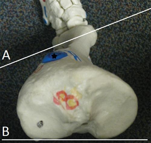 https://cdn.ncbi.nlm.nih.gov/pmc/blobs/b368/3445137/0df1887dc8c1/10.1177_1941738111399372-fig6.jpg