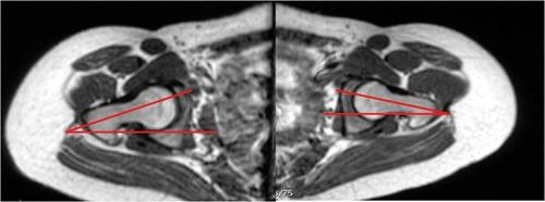 https://cdn.ncbi.nlm.nih.gov/pmc/blobs/b368/3445137/6fca961f9c79/10.1177_1941738111399372-fig12.jpg