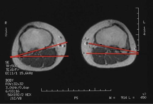 https://cdn.ncbi.nlm.nih.gov/pmc/blobs/b368/3445137/ce65aab073ba/10.1177_1941738111399372-fig14.jpg