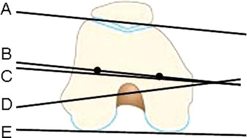 https://cdn.ncbi.nlm.nih.gov/pmc/blobs/b368/3445137/f47958836c71/10.1177_1941738111399372-fig5.jpg