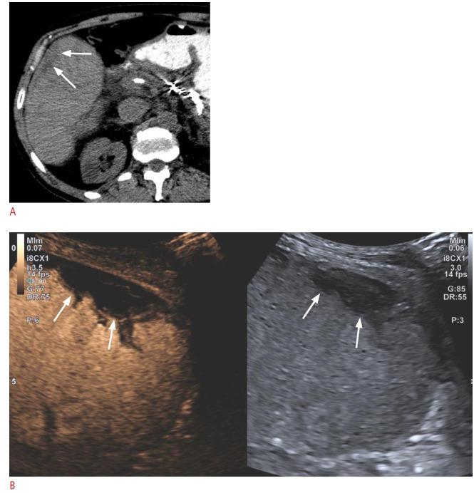 https://cdn.ncbi.nlm.nih.gov/pmc/blobs/b398/11717683/31515411b916/usg-24163f8.jpg
