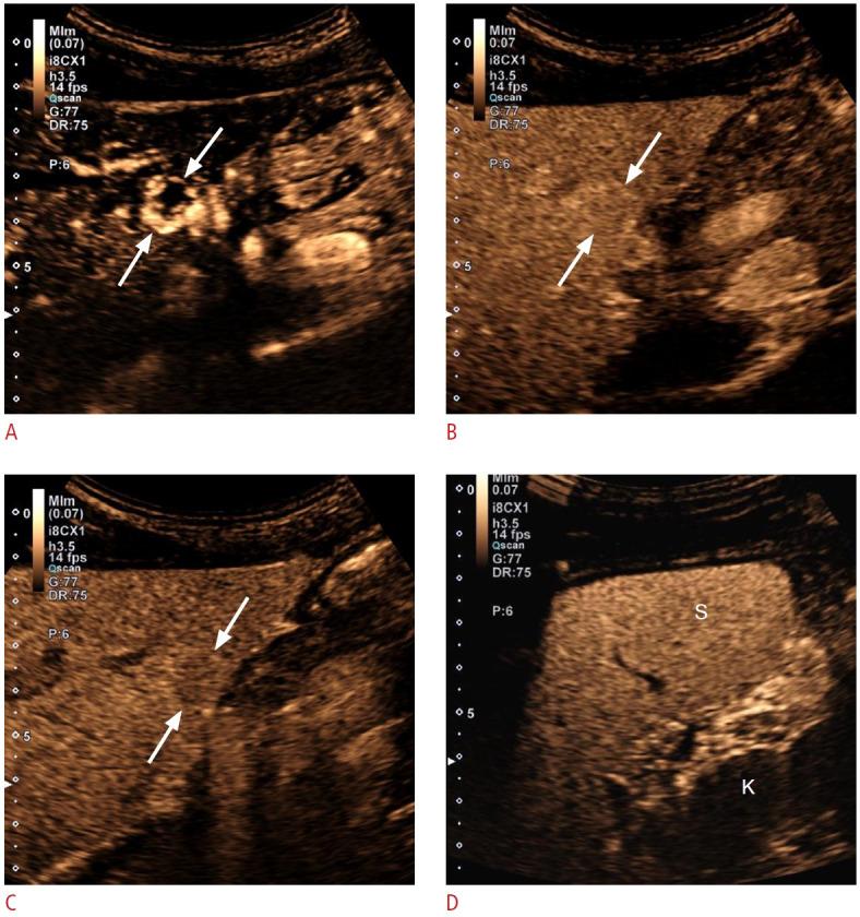 https://cdn.ncbi.nlm.nih.gov/pmc/blobs/b398/11717683/a4781482fed4/usg-24163f6.jpg