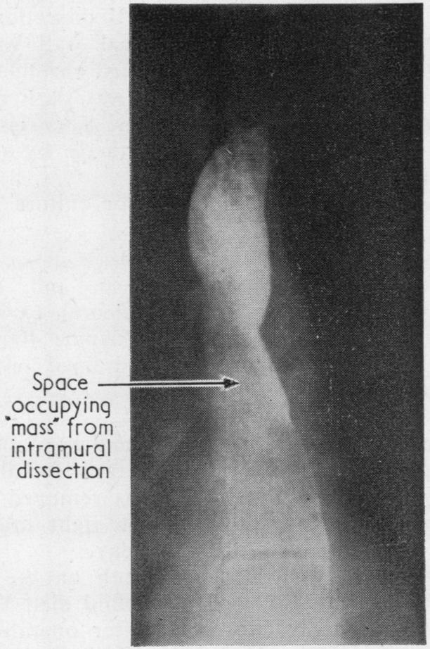 https://cdn.ncbi.nlm.nih.gov/pmc/blobs/b3c4/472699/35d8e51627a5/thorax00111-0039-a.jpg