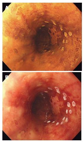 https://cdn.ncbi.nlm.nih.gov/pmc/blobs/b3c7/5605343/c3c1c707427c/WJGE-9-438-g001.jpg