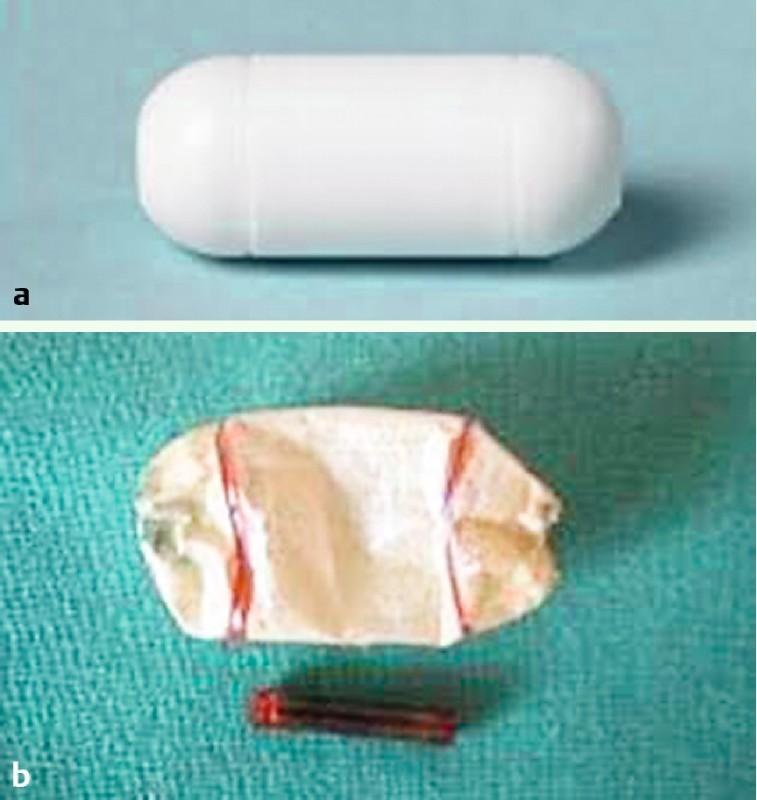 https://cdn.ncbi.nlm.nih.gov/pmc/blobs/b416/5025315/52cfbf8ec0f9/10-1055-s-0042-112588-i606ei1.jpg