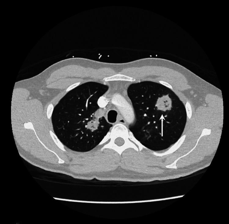 https://cdn.ncbi.nlm.nih.gov/pmc/blobs/b417/8695666/eccad46afeb9/cureus-0013-00000019814-i02.jpg