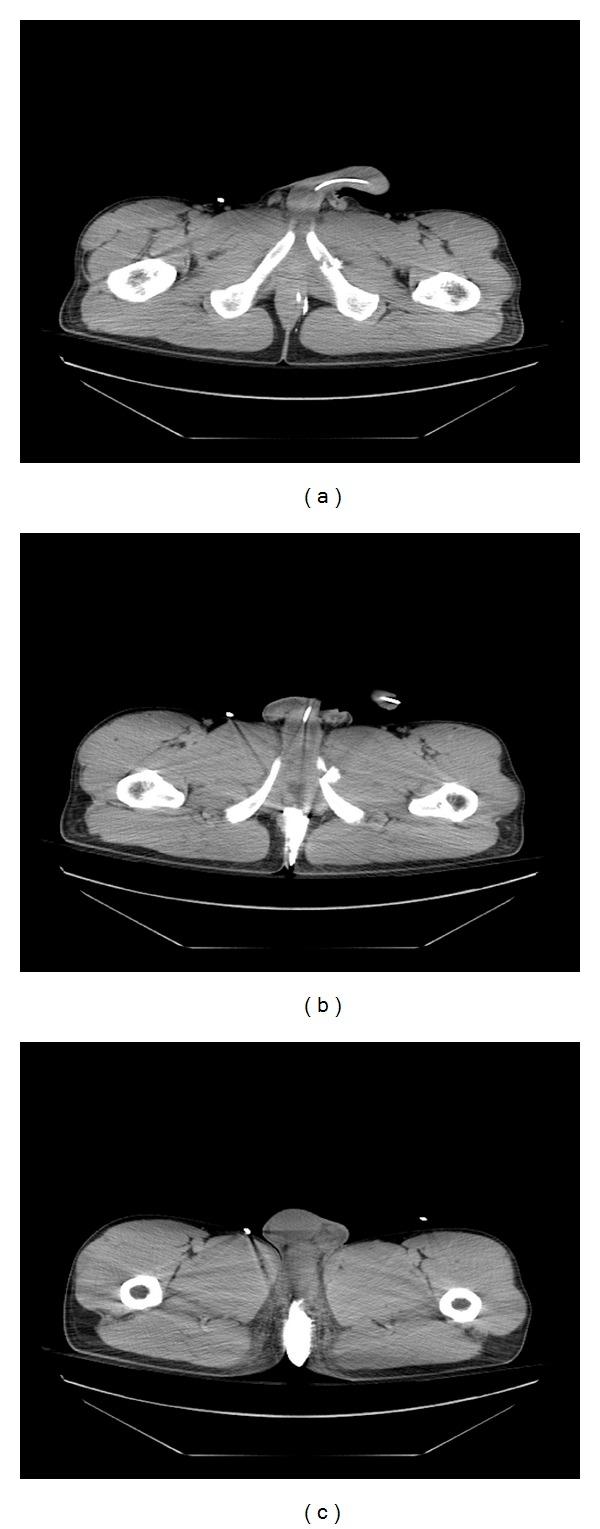 https://cdn.ncbi.nlm.nih.gov/pmc/blobs/b41f/3350194/a4f0aaff03d8/CRIM.UROLOGY2012-109589.002.jpg