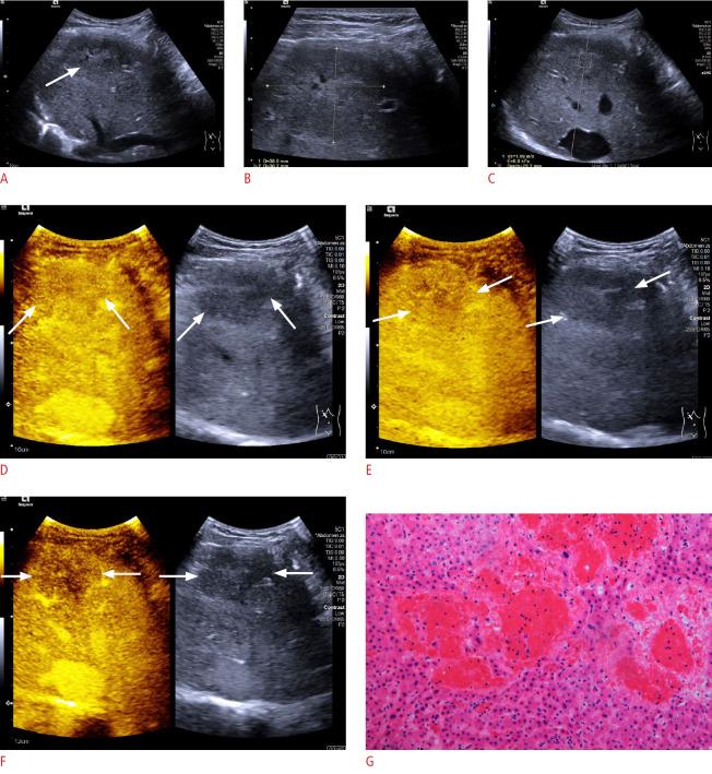 https://cdn.ncbi.nlm.nih.gov/pmc/blobs/b45a/8446485/a1746f44216d/usg-20162f1.jpg