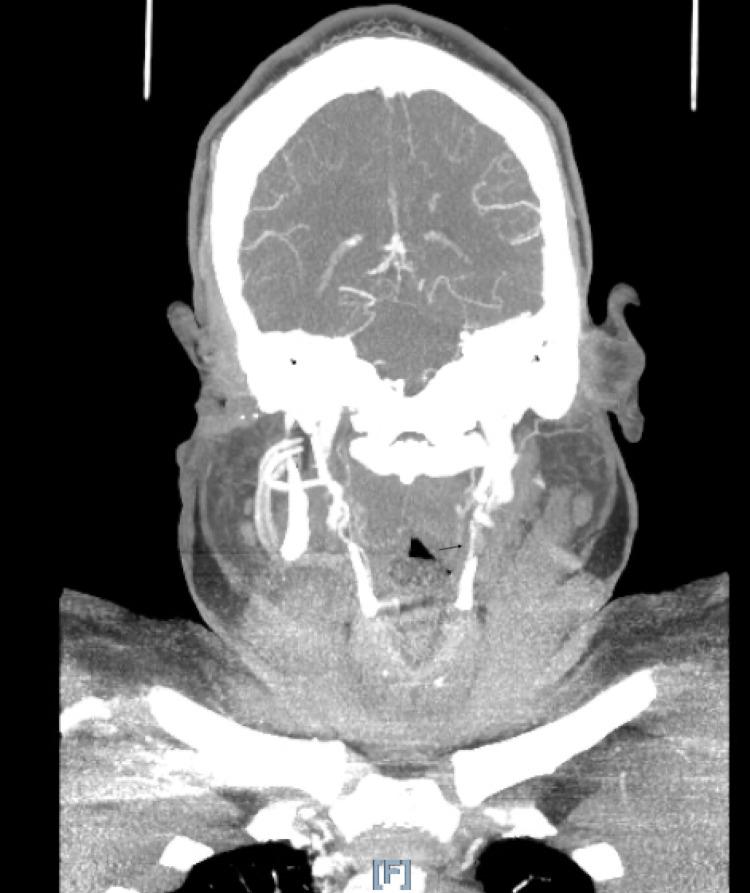 https://cdn.ncbi.nlm.nih.gov/pmc/blobs/b50f/8315787/b111831e2f32/cureus-0013-00000015971-i03.jpg