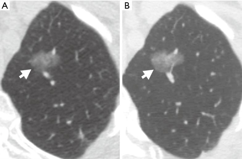 https://cdn.ncbi.nlm.nih.gov/pmc/blobs/b533/7711402/f8d2f1db5e51/jtd-12-11-6966-f1.jpg