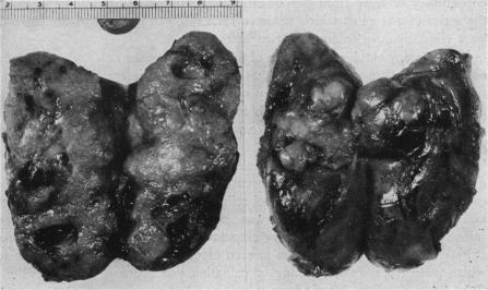 https://cdn.ncbi.nlm.nih.gov/pmc/blobs/b5c0/1618010/13e09f0e4b79/annsurg01453-0070-b.jpg