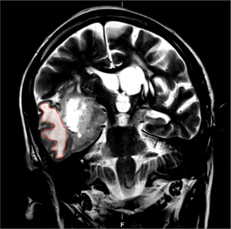 https://cdn.ncbi.nlm.nih.gov/pmc/blobs/b5d1/12255178/b05406d35582/SNI-16-256-g002.jpg