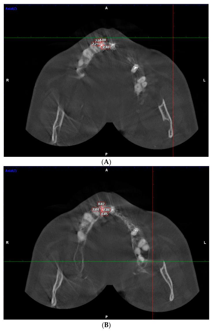 https://cdn.ncbi.nlm.nih.gov/pmc/blobs/b5d9/10217616/c7de26c2d32f/dentistry-11-00124-g001a.jpg