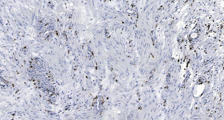 https://cdn.ncbi.nlm.nih.gov/pmc/blobs/b606/5637626/534dcb3cd1fb/amjcaserep-18-1066-g012.jpg